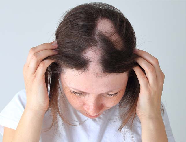 Alopecia Areata Treatment