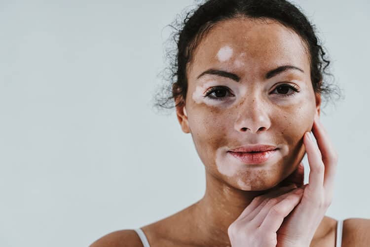 Vitiligo Treatment