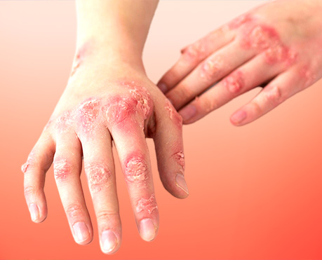 Psoriasis Treatment